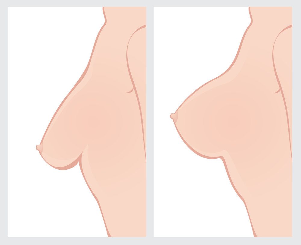 before and after breast lift