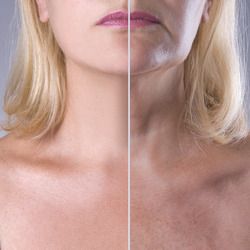 Before and after images of a neck lift patient. 