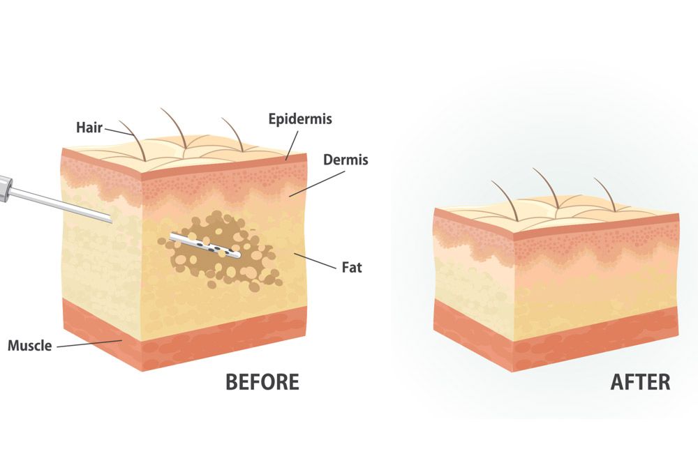 Before and after images of the fat extraction process.