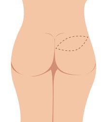 Illustration of the upper buttock area used in superior gluteal artery perforator (SGAP) flap reconstruction surgery.