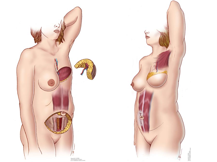 An illustration of the breasts before and after breast reconstruction